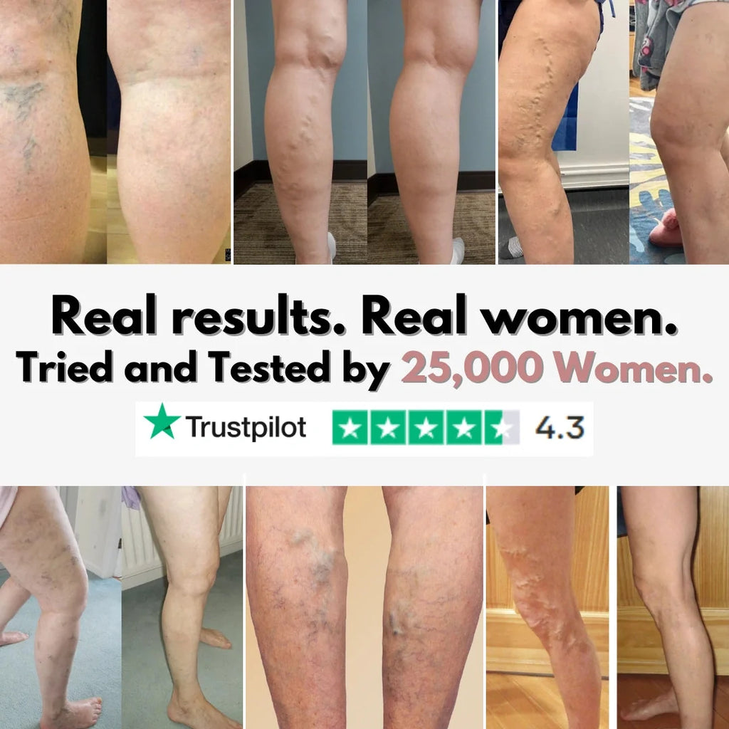 From Spider Vein & heavy legs to visible relief for healthcare workers in 14 days