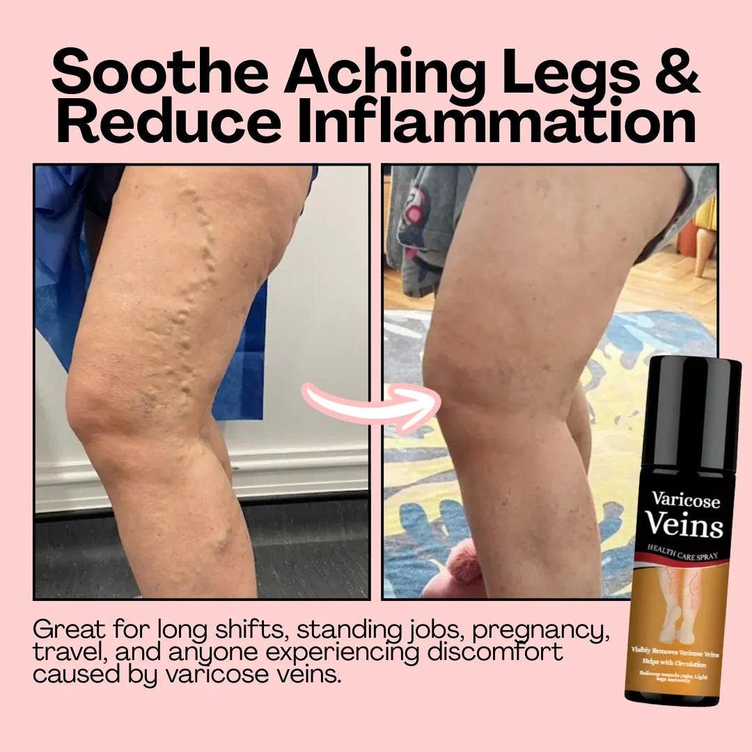 Varicose Vein Spray Leg Pain Gone, Confidence On