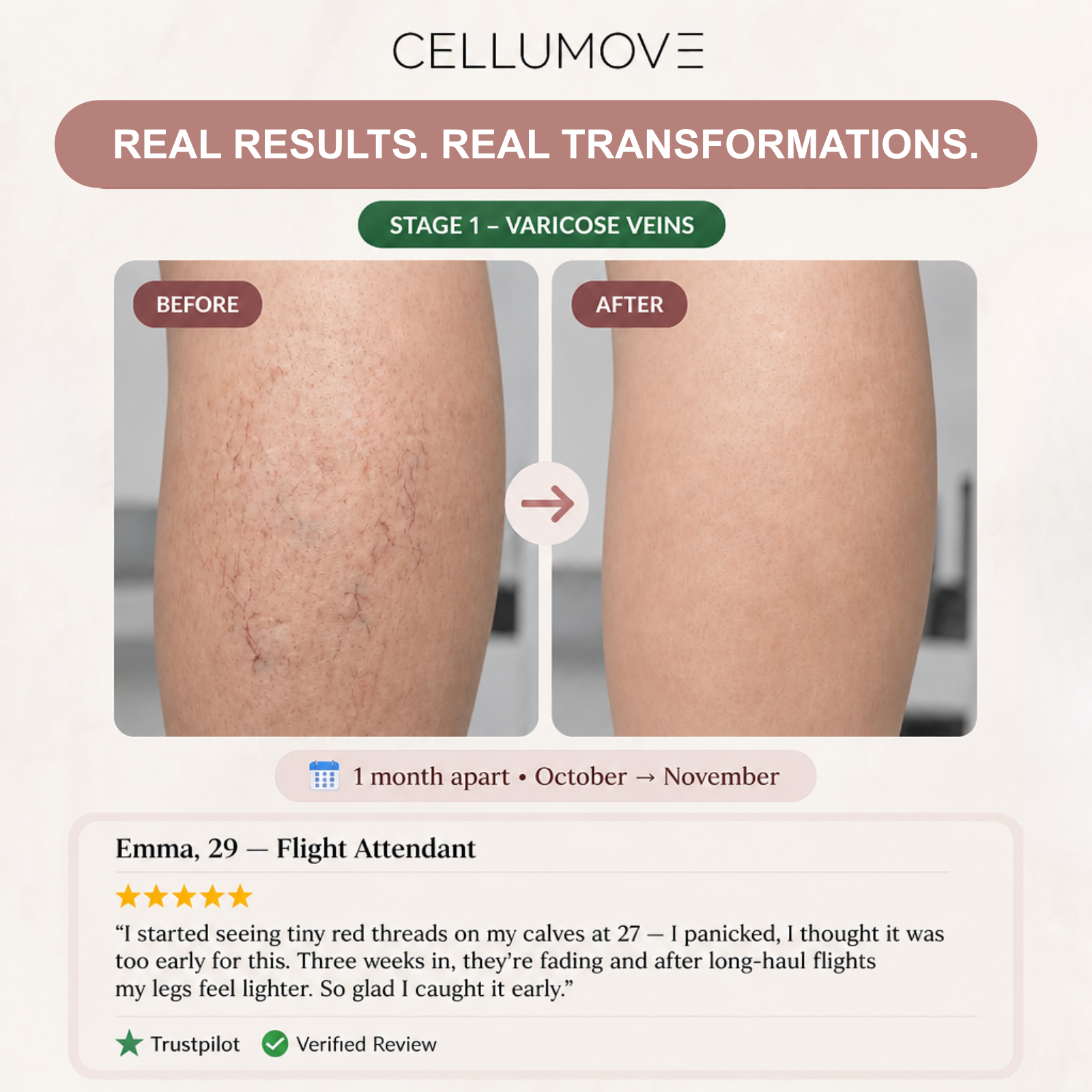 VARICOSE VEINS
