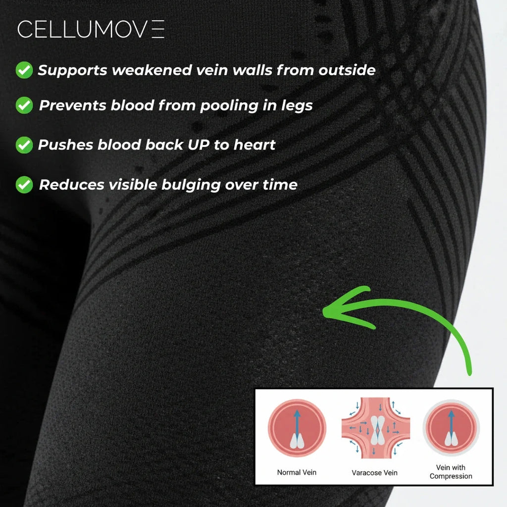 Visible Vein Relief in Just 14 Days with 3D Compression Leggings