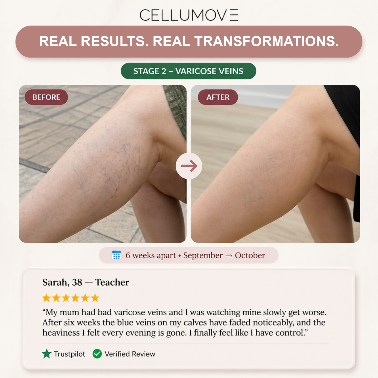 VARICOSE VEINS