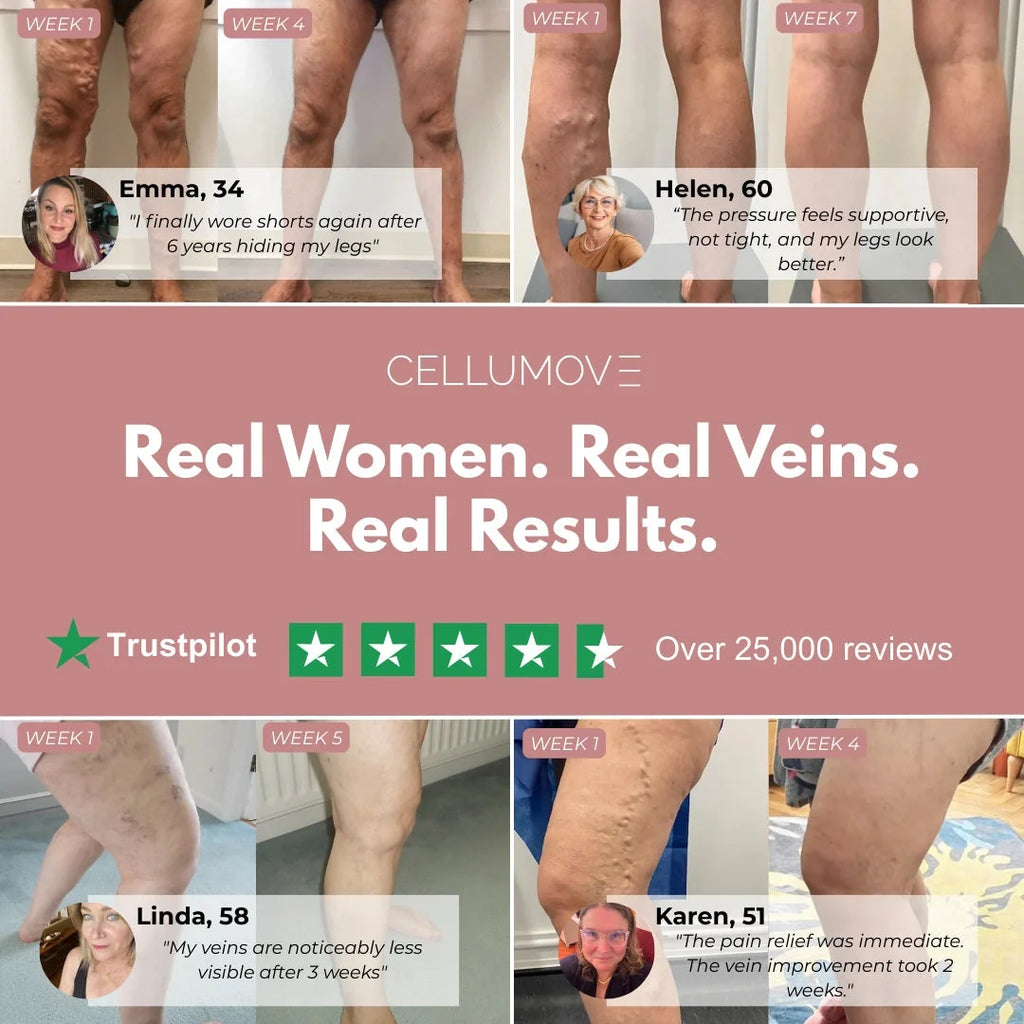 Visible Vein Relief in Just 14 Days with 3D Compression Leggings