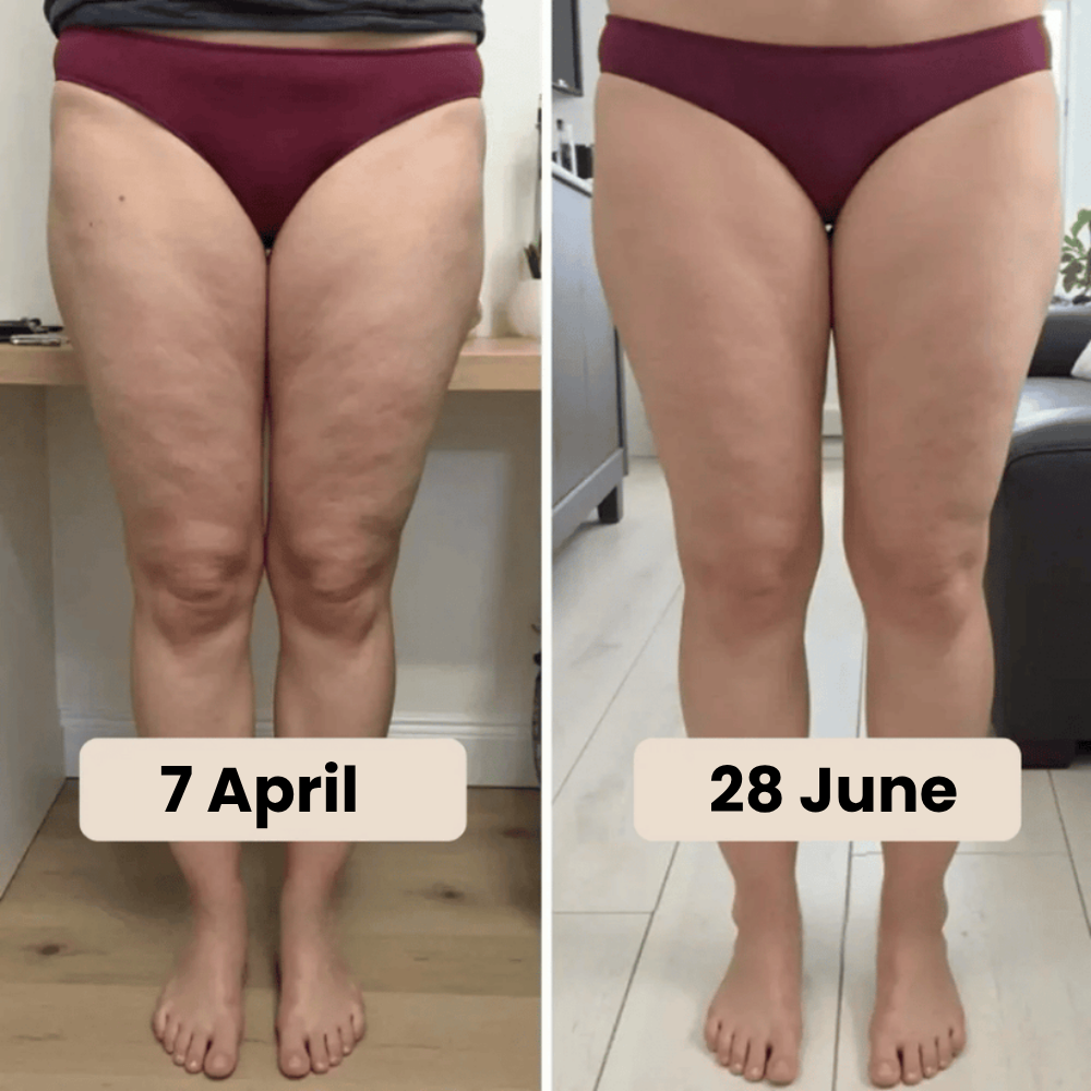 3D Legging – Say goodbye to lipoedema pain and swelling naturally.