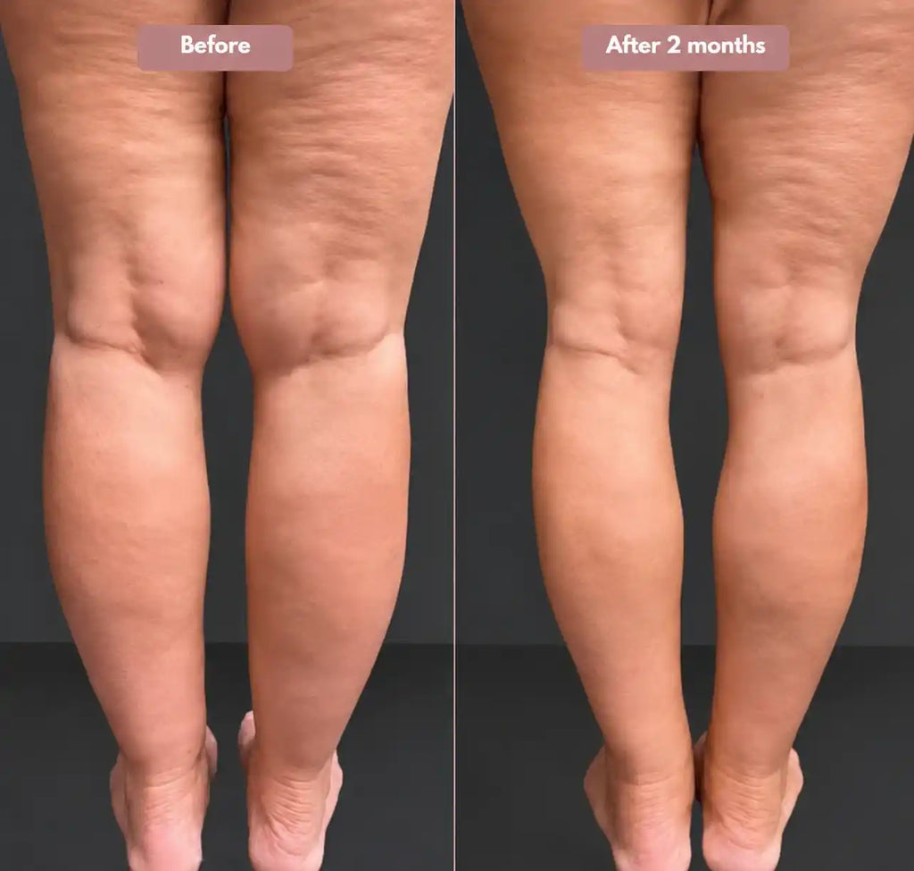 3D Legging – Say goodbye to lipoedema pain and swelling naturally